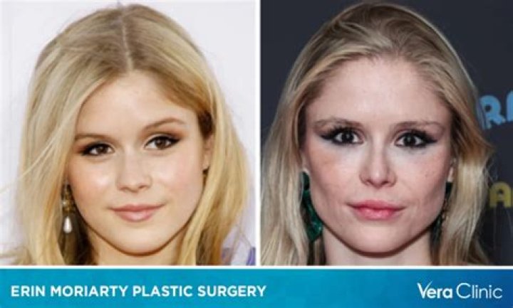 Erin Moriarty Before and After Plastic Surgery: What Happened To Her Face & Has She Lost Weight?