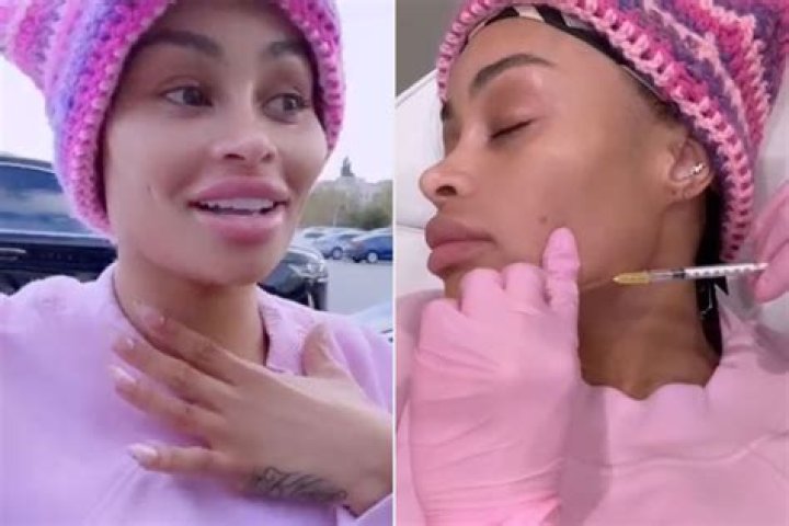 
Pictures of Blac Chyna With and Without Facial Fillers Explored 