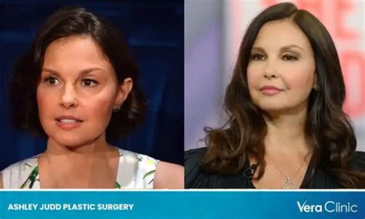 What Happened To Ashley Judd Face? Accident And Surgery Details – Is It Still Swollen Today?